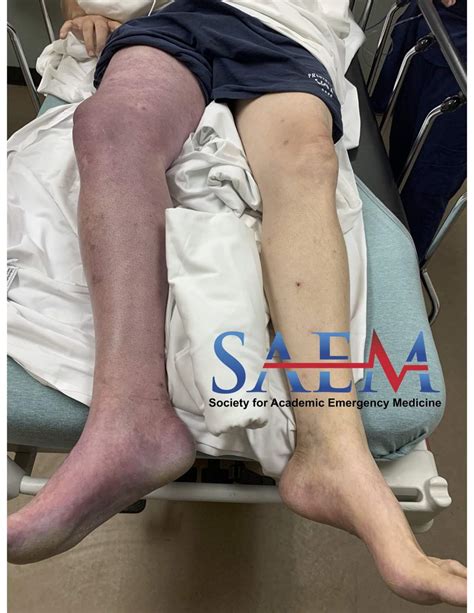 Saem Clinical Image Series Pulseless And Painful Blue Leg