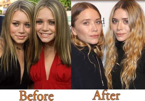 Mary Kate And Ashley Olsen Plastic Surgery Before And After Nose Job