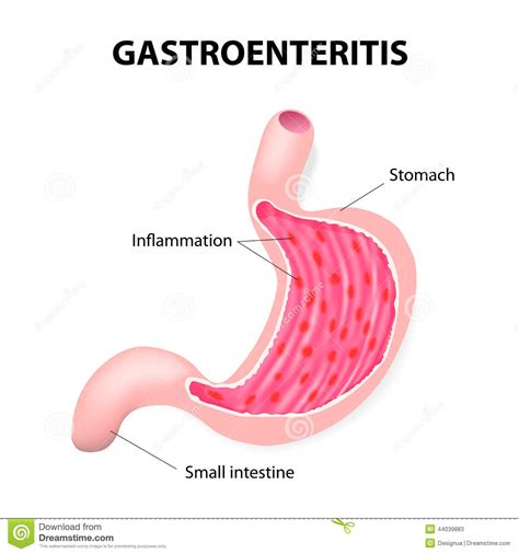 Most of the time, a virus is the culprit, in which case the illness is known as viral gastroenteritis. Stomach Virus Stock Vector - Image: 44039883
