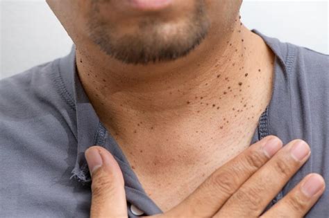 Why You Should Never Remove Skin Tags Yourself Jordan Valley Dermatology Center Dermatologists