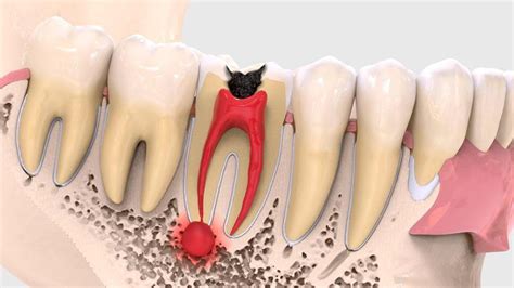 Diagnosing The Symptoms Of All Types Of Dental Cysts The Best Dentist