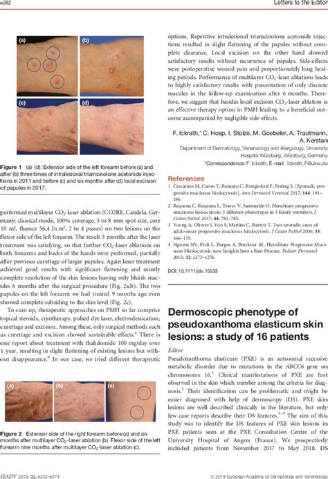 Dermoscopic Phenotype Of Pseudoxanthoma Elasticum Skin Lesions A Study