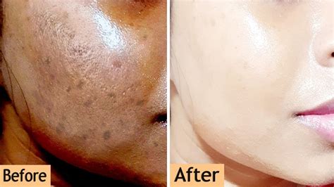 In 3 Days Remove Dark Spots Black Spots And Acne Scars Instant Skin