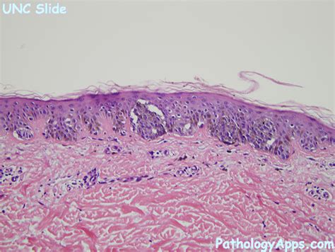 Junctional Nevus Skin Histology