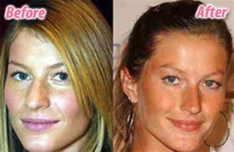 Stars Before And After Plastic Surgery 47 Pics