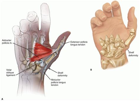 Operative Treatment Of Thumb Carpometacarpal Joint Fractures Musculoskeletal Key