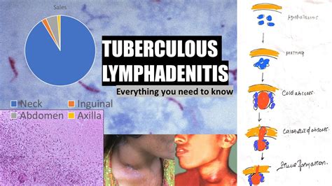 Tuberculous Lymphadenitis Stages Of Cervical Lymphadenitis Cold