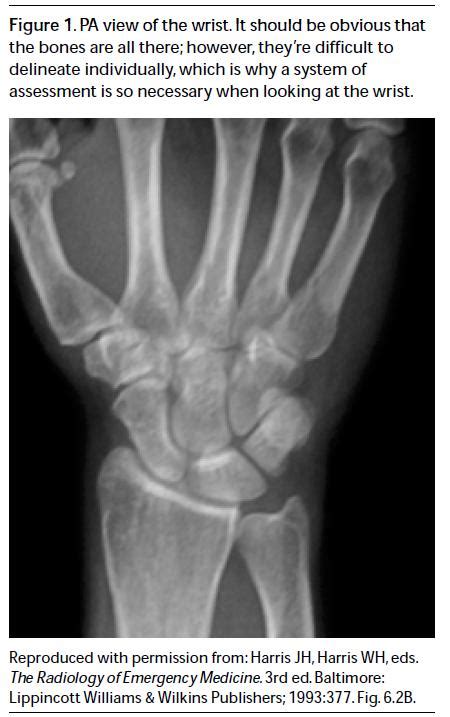 Wrist Injuries Emergency Imaging And Management