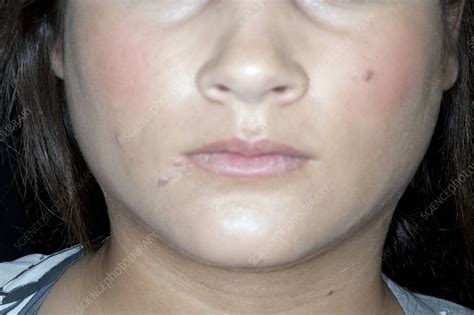Swollen Parotid Glands In Mumps Stock Image C0111827 Science