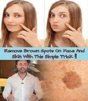 Simple Trick To Remove Brown Spots From Your Skin Simple Tricks