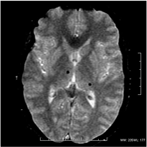 Brain Mri Findings In Patients With Fabry Disease Journal Of The