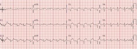 Dr Smiths Ecg Blog Progression Of Anterior Stemi With Rbbb And