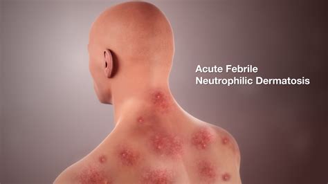 Acute Febrile Neutrophilic Dermatosis Shown Using Medical Animation Still