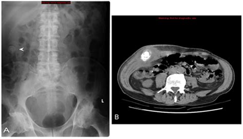 Spontaneous Cholecystocutaneous Fistula Bmj Case Reports