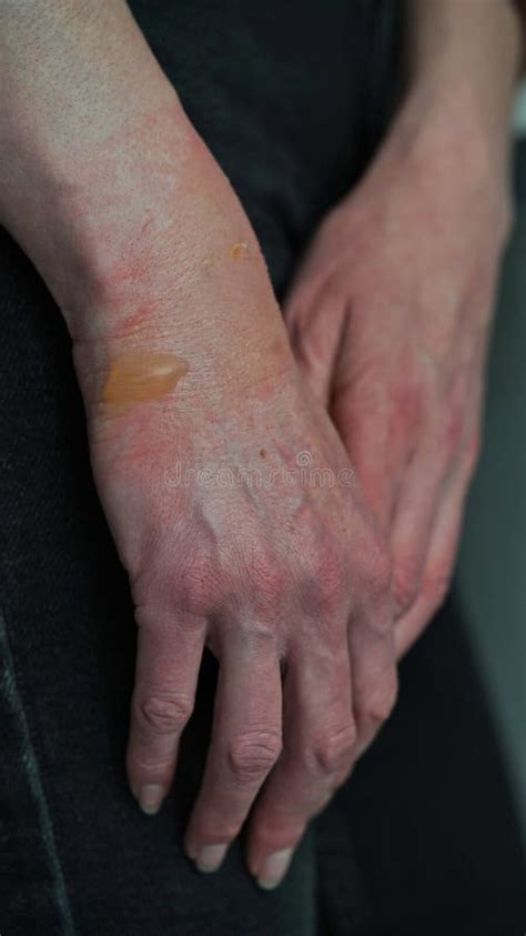 Close Up Of A Woman S Hand With A Blister From A Boiled Water Burn