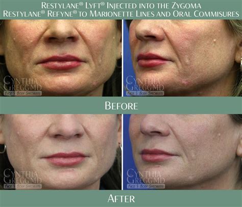Nasolabial Folds And Marionette Lines Cynthia Gregg Md Face And Body