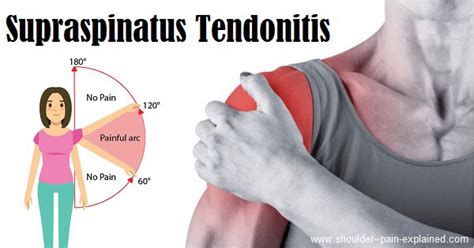 Supraspinatus Tendonitis Causes Symptoms Treatment Supraspinatus Hot Sex Picture