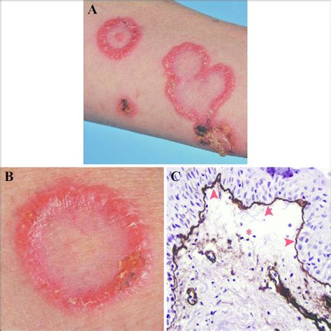 Tinea Corporis Bullosa Due To Microsporum Canis Mimicking Linear Iga