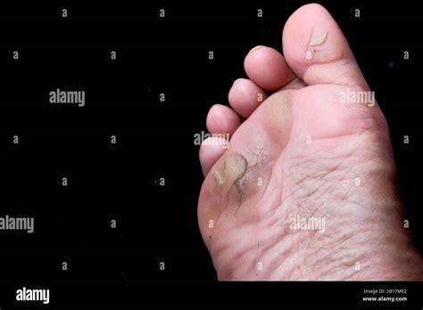 Infecci N De Los Pies De La Epidermis Externa Enfermedades De La Piel