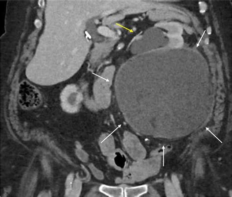 Follow Up Ct Coronal Ct Demonstrates Large Retroperitoneal Urinoma Download Scientific