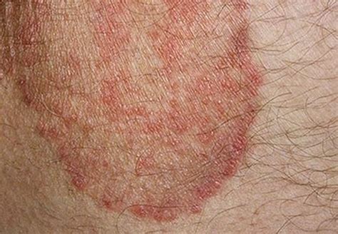Skin Rashes That Itch All Over Body Retyperfect