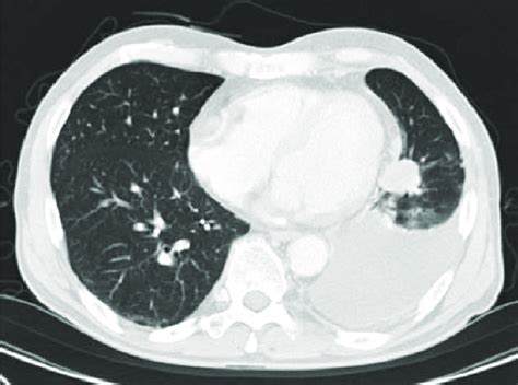 Chest Computed Tomography Ct In August 2007 Chest Ct Scan Showing A