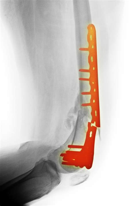 Maybe you would like to learn more about one of these? Broken Metal Implants In Your Body