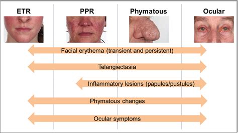 Updating The Diagnosis Classification And Assessment Of Rosacea