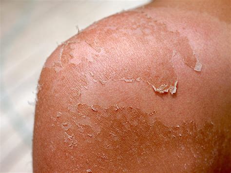 How To Cure Peeling Skin Battlepriority6