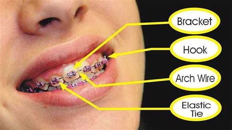 The Parts Of Orthodontic Braces Ask An