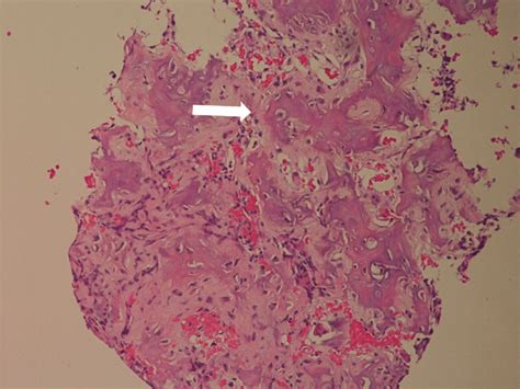 Histologic Specimen Of The Osteoid Osteoma The Central Nidus Of The