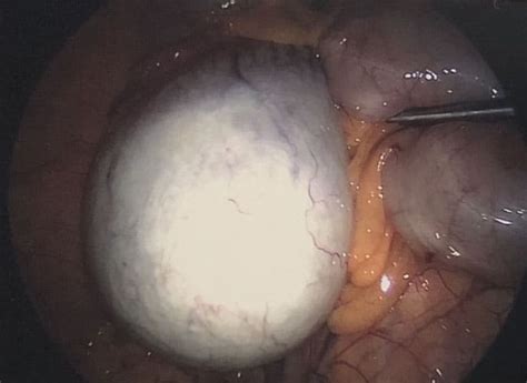 My Experience Having A Dermoid Ovarian Cyst Removed During Pregnancy