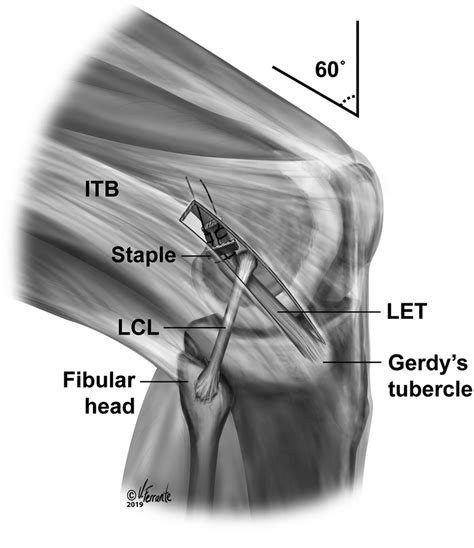 Anterolateral View Of The Knee Illustrating The Technique Used For Let
