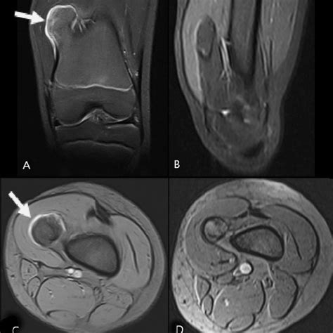 Mri Fat Saturated T2 Weighted Images Of The Left Knee In Coronal And