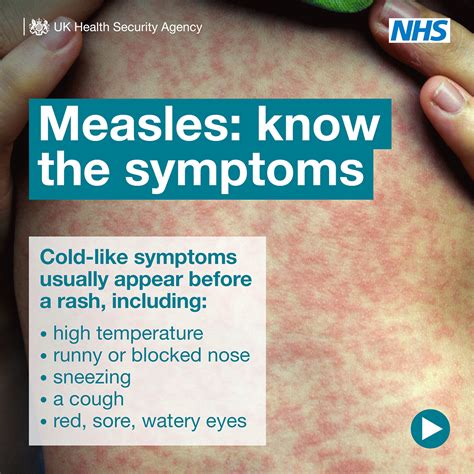 Measles Latham House Medical Practice