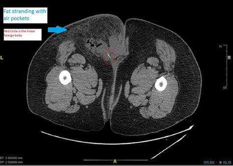 Cureus Gluteal Abscess Secondary To Rectal Perforation Due To Ingested Foreign Body A Report