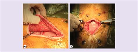 Retrorectus Repair Of Incisional Ventral Hernia With Urinary Bladder