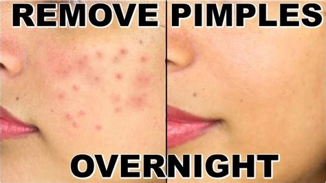 Face Pimples And Red Spots Removal Home Remedy How To Remove Pimples