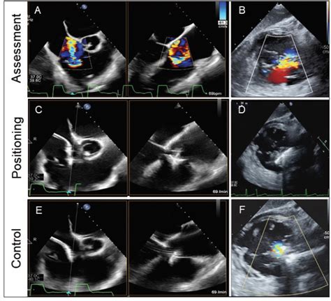 Patient Selection And Periprocedural Imaging For Transcatheter