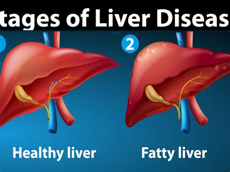 Fatty Liver Diet Plan Archives