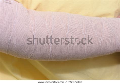 Lymphedema Management Wrapping Lymphedema Hand Arm Stock Photo