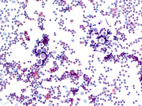 Pathology Outlines Cryptococcus