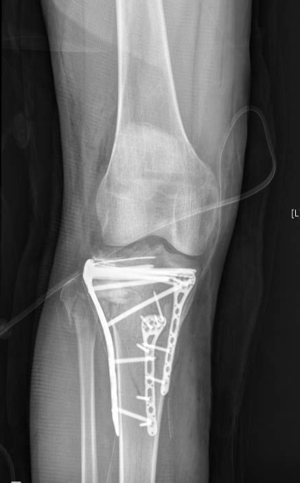 Tibial Plateau Fracture Surgery Wikidoc