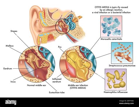 Medical Illustration Of The Symptoms Of Otitis Media Stock Photo Alamy