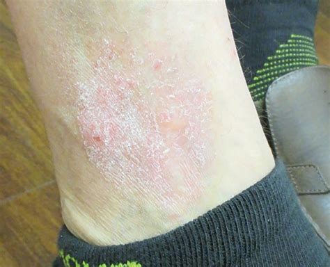 Prime Fin Avare Dry Skin Rash On Legs Ancien Belle Femme Centre Ville