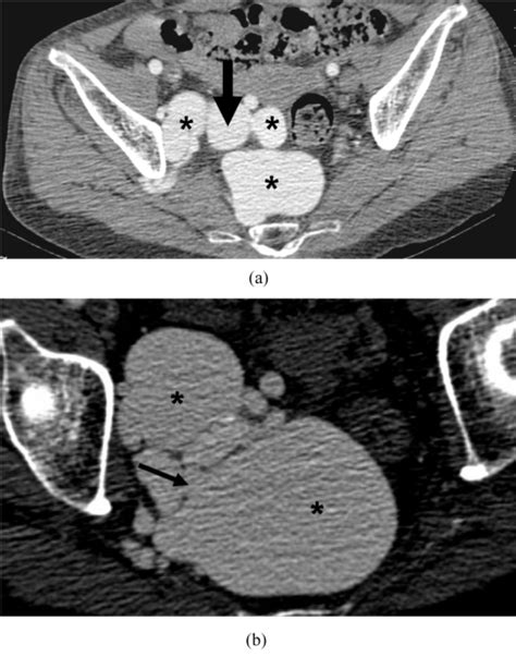 Contrast Enhanced Axial Ct At The Level Of The Pelvis A The Enlarged