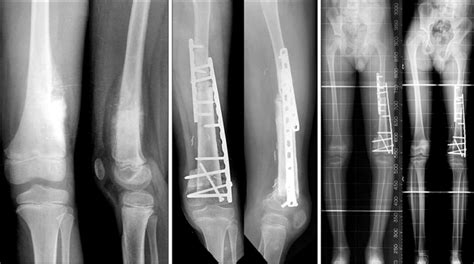 Plain Radiographs Showing Osteosarcoma On Left Distal Femur