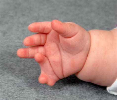 Small Finger Polydactyly Extra Fingers Congenital Hand And Arm Differences Washington