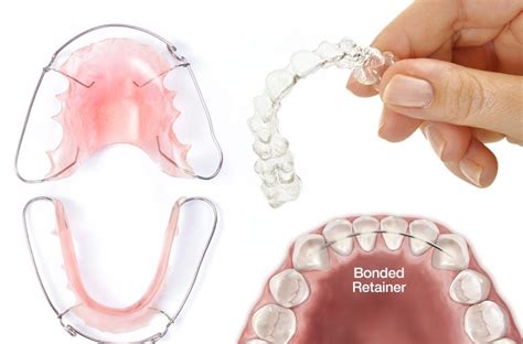 A good rule of thumb is that you will need your retainer just a little longer than the amount of time you had your braces in. Primary How Long Do I Have To Wear My Retainer At Night ...
