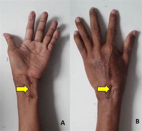 Cureus Isolated Tuberculosis Of The Wrist Subtle But Destructive
